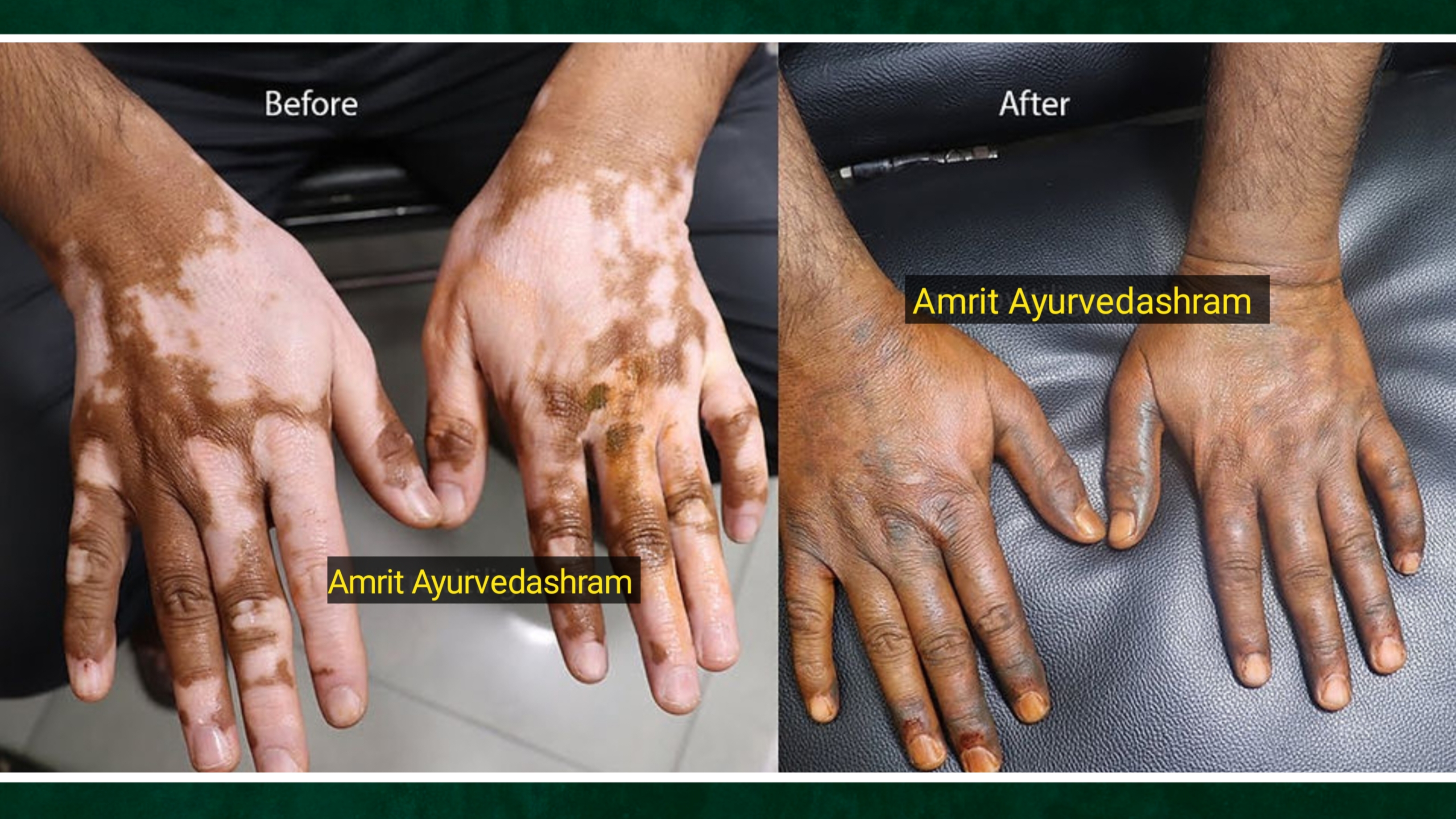 Vitiligo before and after Ayurvedic treatment